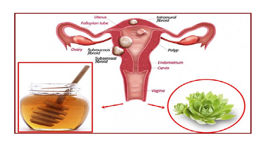 Un mélange de ces 2 ingrédients tue les kystes et les fibromes