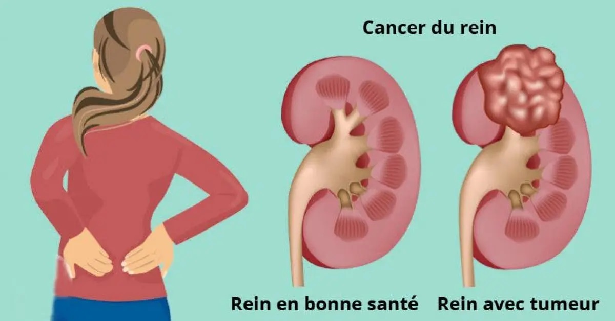 7 symptômes du cancer du rein auxquels il faut faire attention