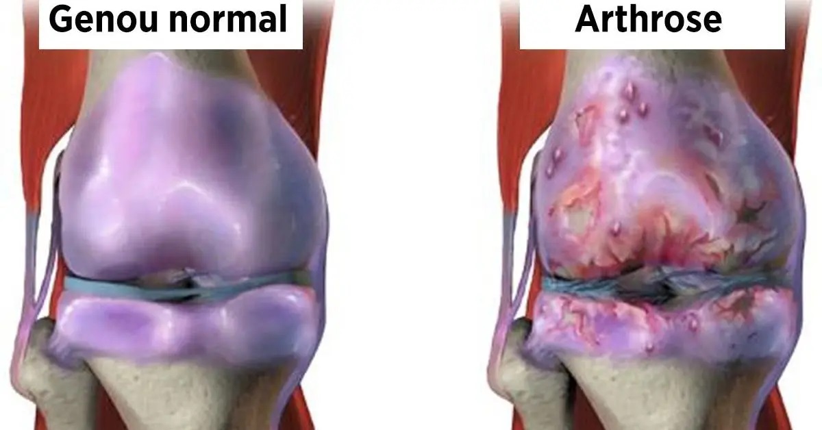 Remèdes naturels scientifiquement prouvés pour la douleur articulaire et l’arthrose du genou